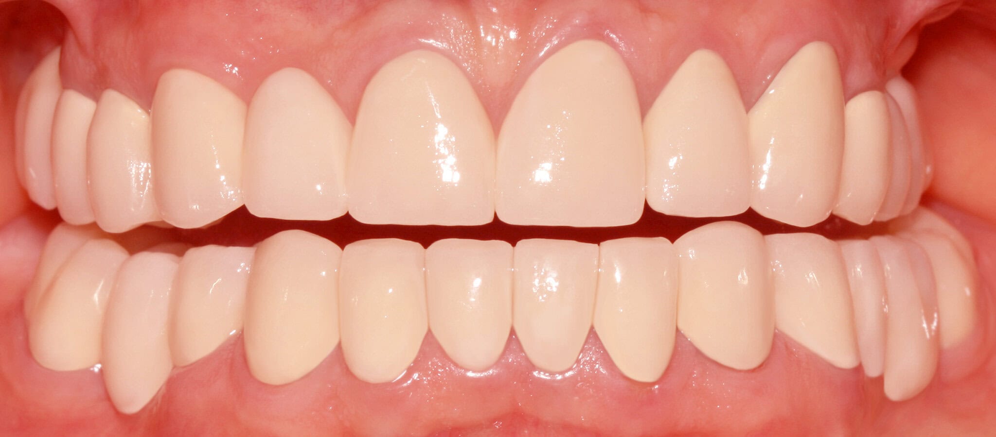 Crowns and fixed bridges after bruxism, after