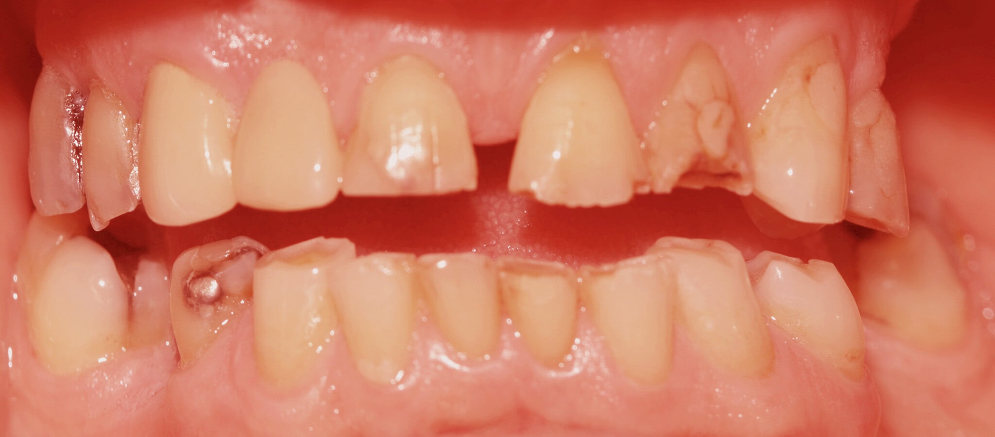 Crowns and fixed bridges after bruxism, before