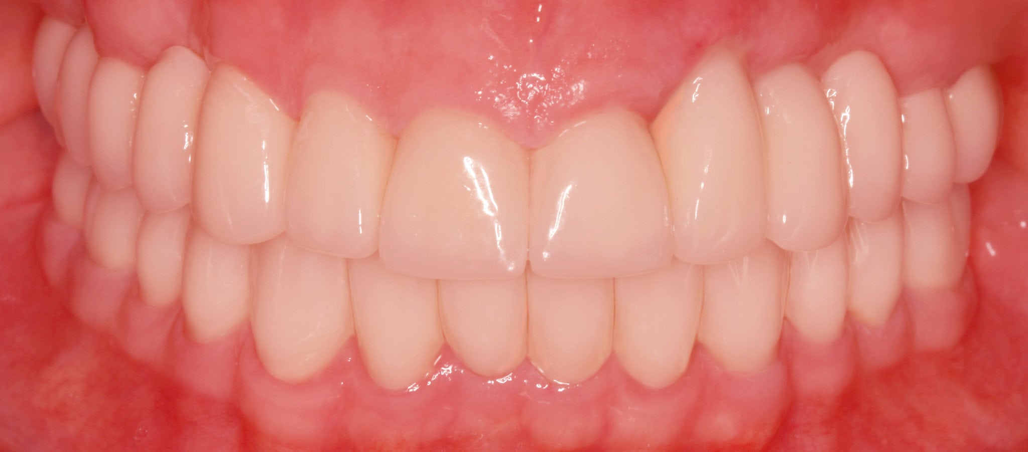 Fixed dental bridge, after