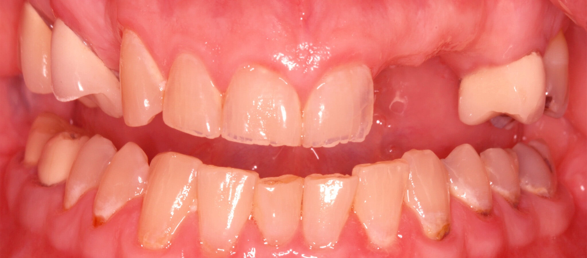 Fixed dental bridge, before