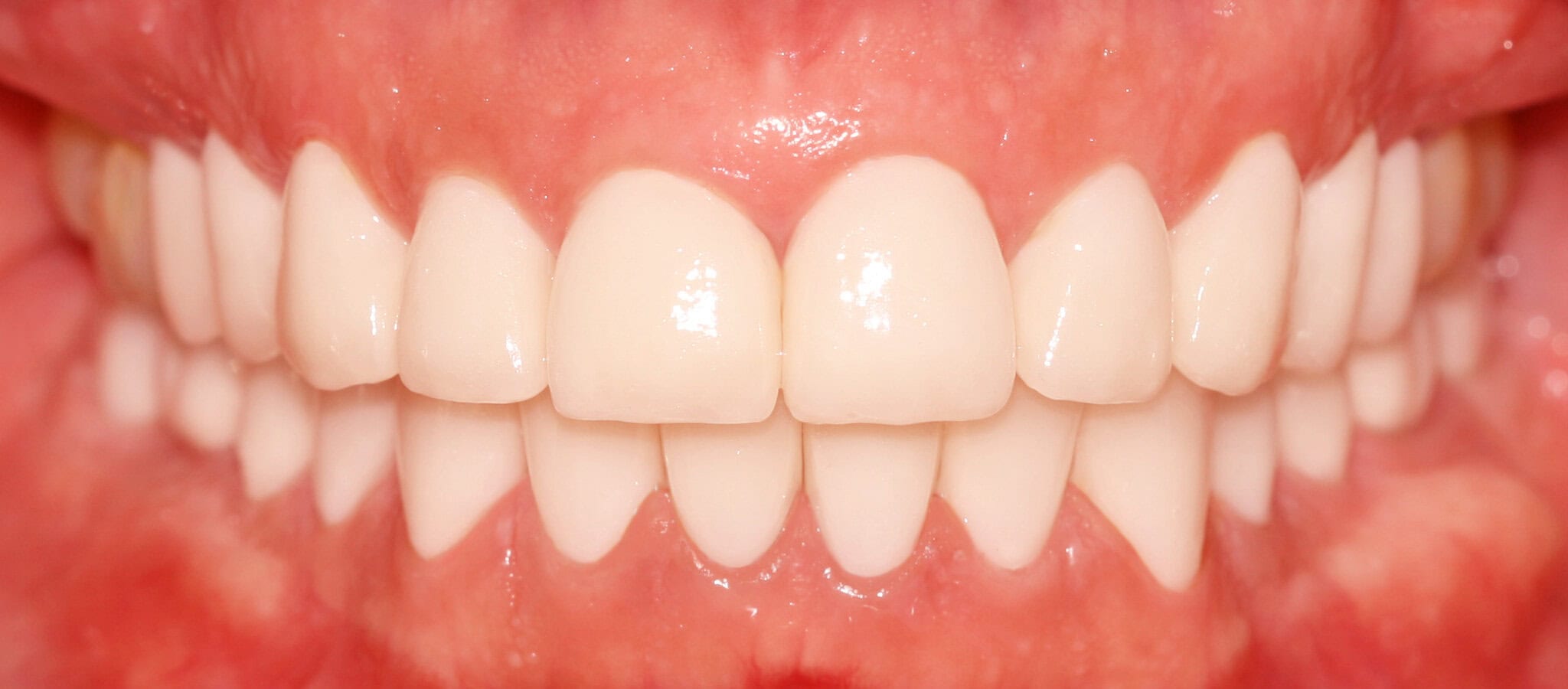 Full oral rehabilitation with individual crowns, after