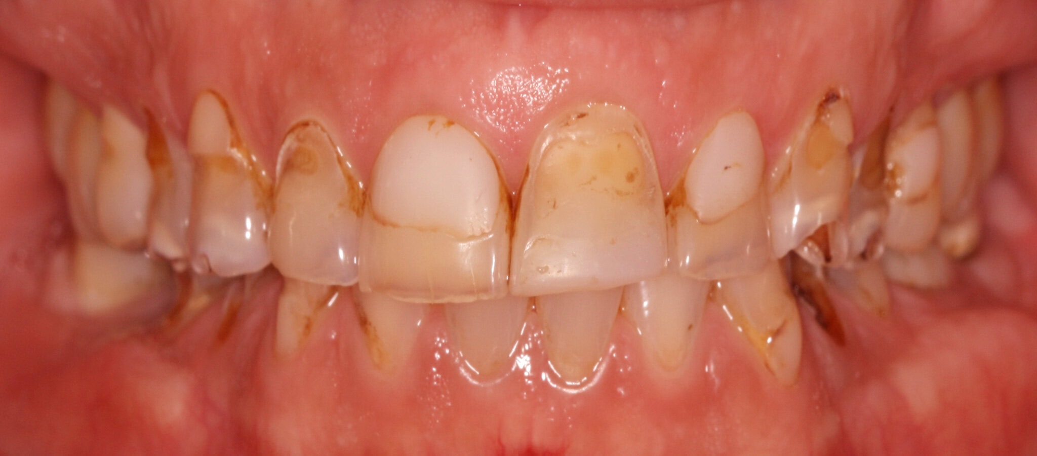Full oral rehabilitation with individual crowns, before