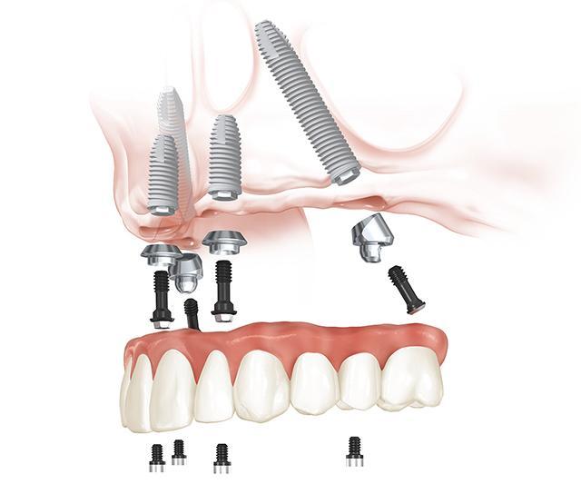 All-on-4 dental implants upper jaw