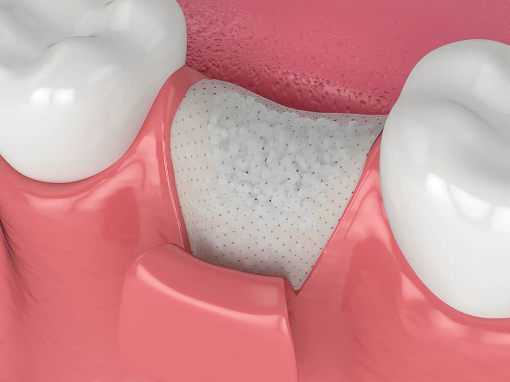Bone graft procedure illustration