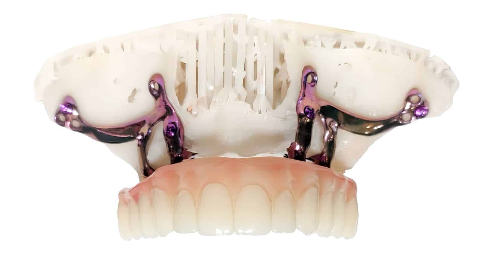 Titanium subperiosteal implant framework 3D printed on the Riton printer at New Smile
